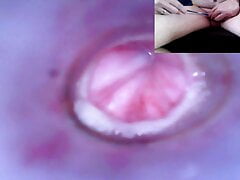 Trip down the urethra with two cameras