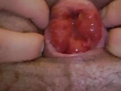 anal prolapse