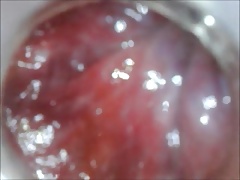 anal deep insertion endoscope inside