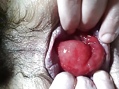 Prolaps