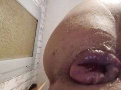 Anal destruction