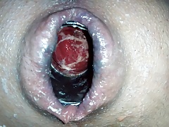 Anal insertion i6