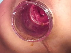 Pink rectum Dec-13-2018