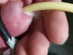 Electrocum around 22 Fr Catheter